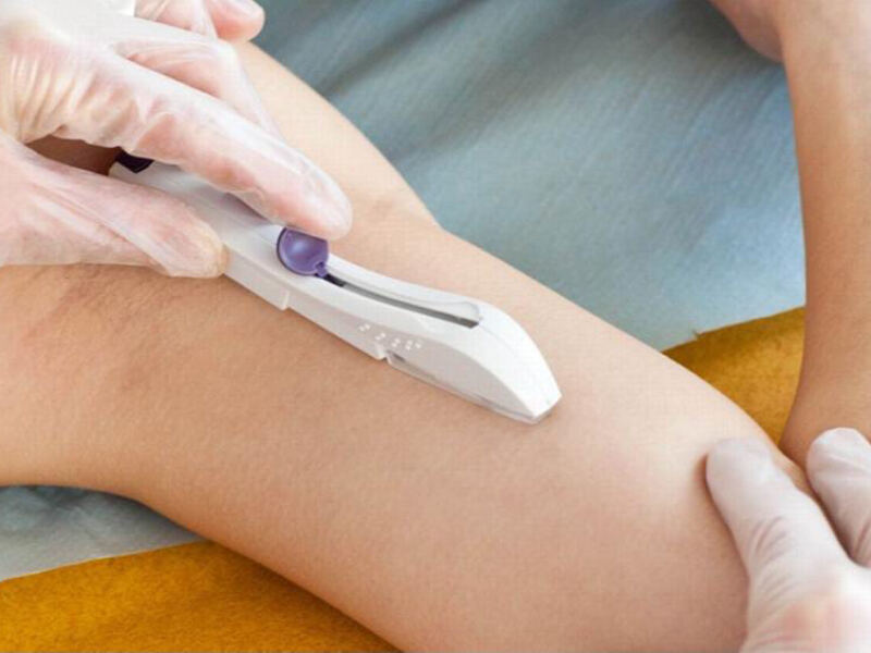 Berisso: Realizarán jornadas de colocación y extracción de implantes anticonceptivos subdérmicos